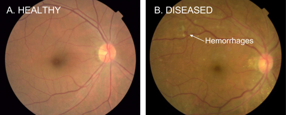 Computer vision algorithms can be used to process retinal fundus photographs to screen for diabetic retinopathy.