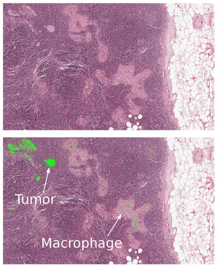 Applying computer vision technology during a lymph node biopsy can help detect the tumor region. 